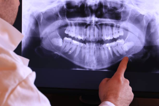 Best Emergency Dental Extractions in Cartersville, GA