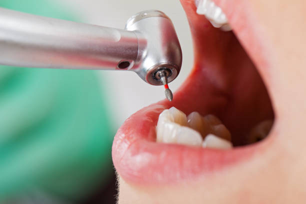 Best Emergency Root Canal Treatment in Cartersville, GA